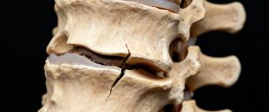 fractura vertebral l1 por negligencia
